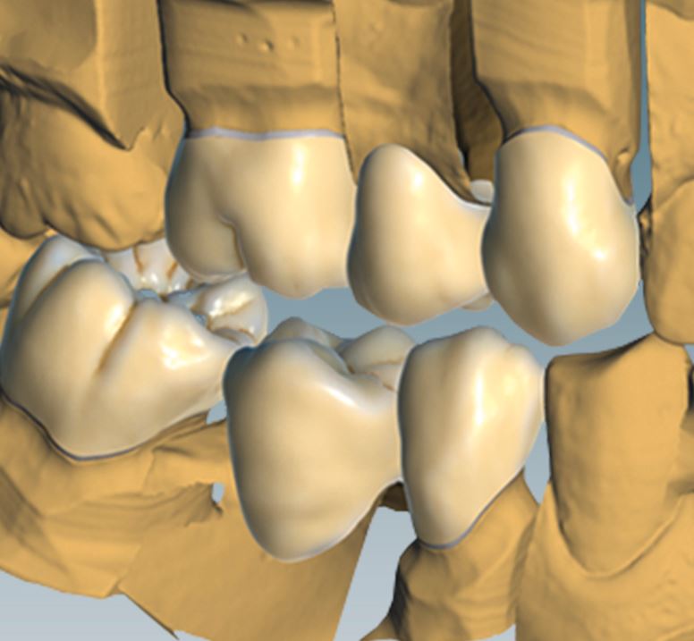 CERAMILL TRUE SMILE UPGRADE