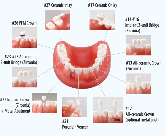 Nissin Aesthetic Dental Restoration Model PRO020