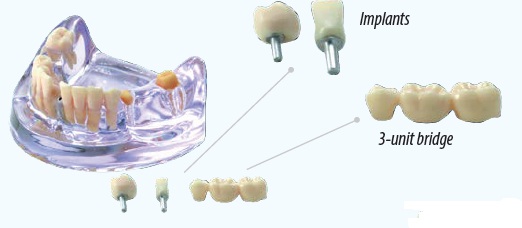 Nissin Implant Model IMP003