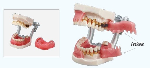 [NISPE-PER003] Perio Disease Model PE-PER003 Nissin