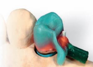 [BE52822] WIROFIX FRICTION ELEMENTS STANDARD