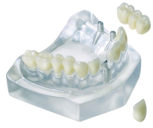 [SAMODC2] MODEL 3 UNIT BRIDGE/2 IMPLANT & 1 CROWN