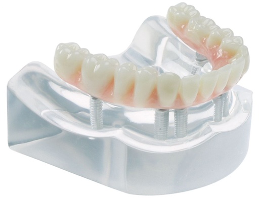 [SAMODHWB6] MODEL 6 IMPLANT HIGH WATER BRIDGE