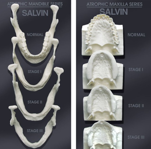 [SAMODSET] BONE LOSS MODEL SET