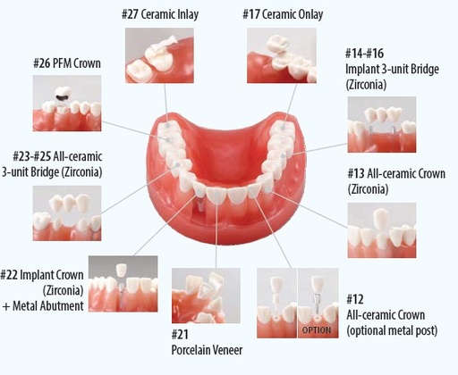 [NISPE-PRO020] Nissin Aesthetic Dental Restoration Model PRO020